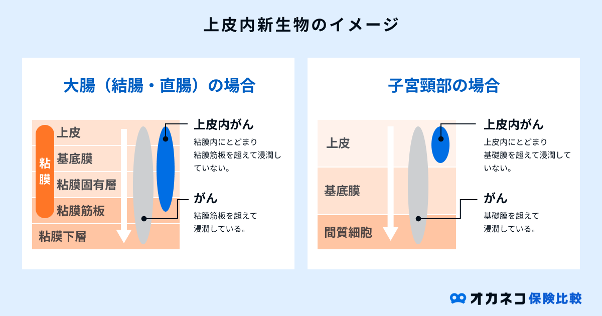 上皮内新生物のイメージ